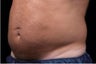 Liposonix