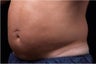 Liposonix