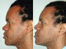 45 year old Afro-Hispanic Male Rhinoplasty