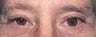 Upper & Lower Eyelid Surgery Combination Procedure