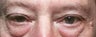 Upper & Lower Eyelid Surgery Combination Procedure