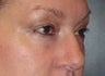Restylane