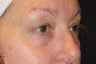 Restylane