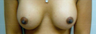 Breast Enhancement