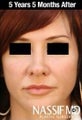 Female Primary Rhinoplasty