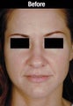 Female Primary Rhinoplasty