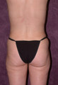 Mommy makeover - Lipo, tummy tuck