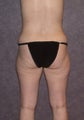 Mommy makeover - Lipo, tummy tuck