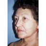 Neck Lift