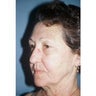 Neck Lift