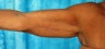 Female Arm Lift