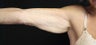 Female Arm Lift