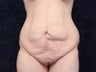 31 Year Old Woman After Massive Weight Loss