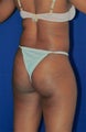 Brazilian Butt Lift