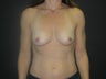 One Step Bilateral Breast Reconstruction