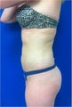 Laser Liposuction
