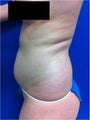 Laser Liposuction