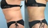 Revision Liposuction