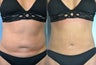 Revision Liposuction