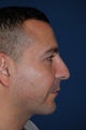 Male with Cheek and Chin Implants