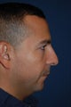 Male with Cheek and Chin Implants