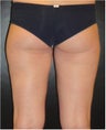 SmartLipo MPX
