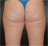 SmartLipo MPX