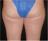 SmartLipo MPX