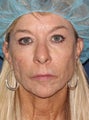 56 year old female with wrinkles around mouth and eyes