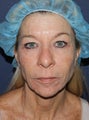 56 year old female with wrinkles around mouth and eyes