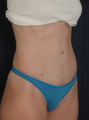 Tummy Tuck after Twin Pregnancy