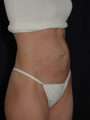 Tummy Tuck after Twin Pregnancy