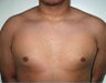 Adolescent Male treated for Breast Reduction