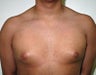 Adolescent Male treated for Breast Reduction