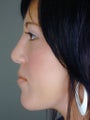 Female Chin Implant