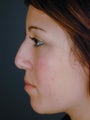 Female Chin Implant