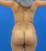 Butt Lift