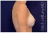 Breast Augmentation