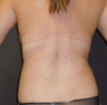 Liposuction
