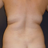 Liposuction