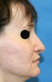 Rhinoplasty