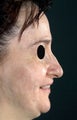 Rhinoplasty