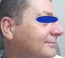 50 year old male treated for age spots