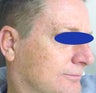50 year old male treated for age spots