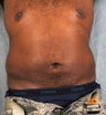 Liposuction of Hips & Abdomen