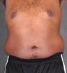 Liposuction of Hips & Abdomen