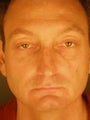 Male Primary Rhinoplasty