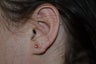 26 year old female before and 3 weeks after torn earlobe repair