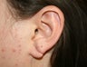 26 year old female before and 3 weeks after torn earlobe repair