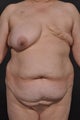 Breast Reconstruction